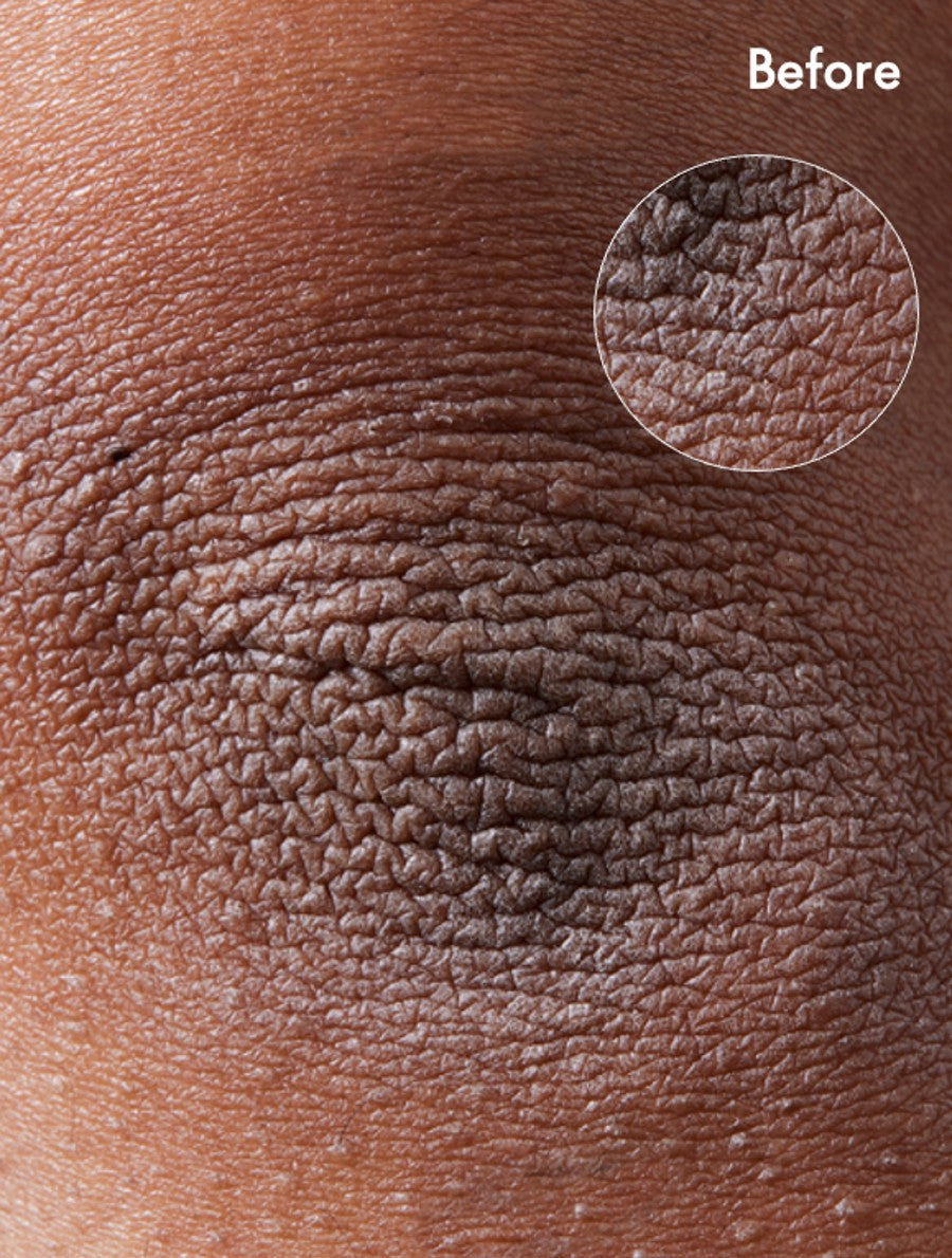 101 Dry Skin Super Cream before shot