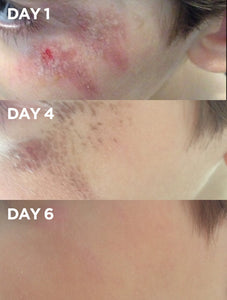 Before & After of Child's Graze using Golden Dry Skin Miracle Salve